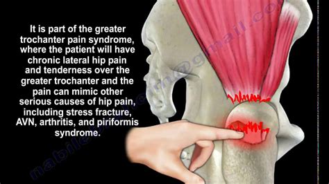 gluteus medius tears surgery